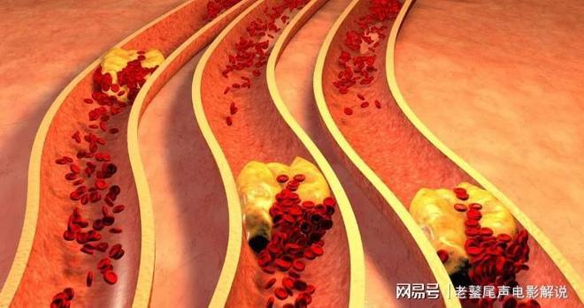 马上停止5类运动很可能加速血栓形成！等血管“堵死”就迟了(图2)