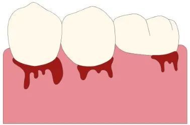 剧烈运动后嘴里的血腥味到底是怎么来的？(图4)