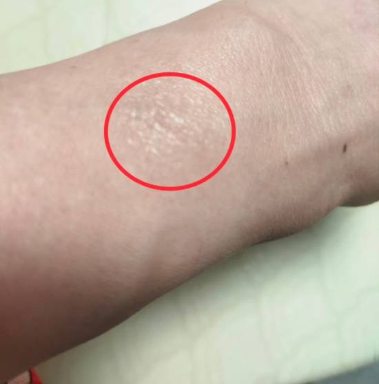 第一批戴运动手环的“受害者”出现了：手腕发白粗糙真凶却不是绿光(图1)